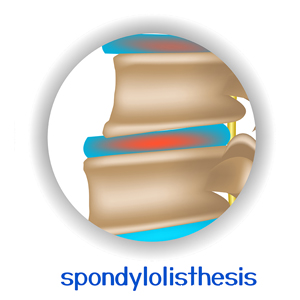 picture of Millville spondylolisthesis